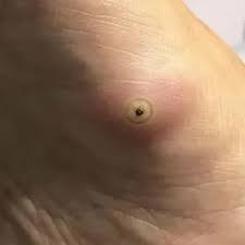 Sonhar com bicho de pé